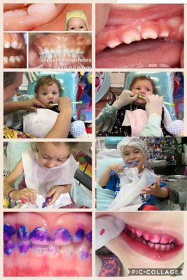 Import�ncia do Fl�or na preven��o da c�rie dental