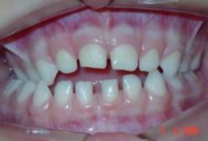 Mordida errada em crianças: Prevenir e Tratar é possível