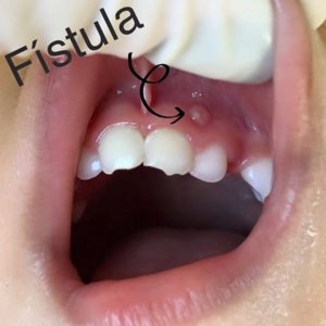 Fístula é um sinal clínico